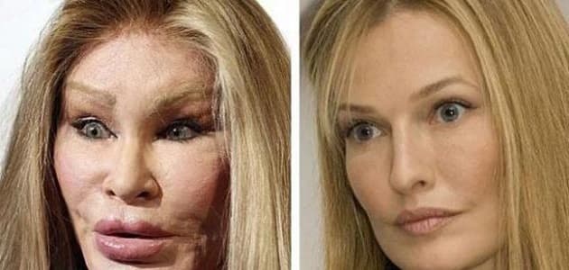 أكثر من 8 أخطار عمليات التجميل الشائعة على المرأة : 2 أضرار عمليات التجميل